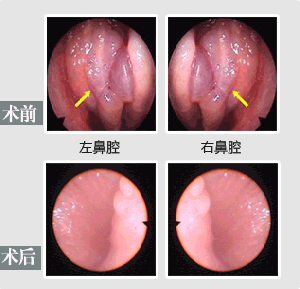 鼻息肉手术有用吗？鼻息肉怎么治果好？